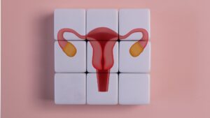 Polycystic Ovary Syndrome