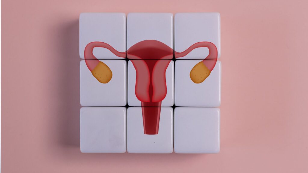 Polycystic Ovary Syndrome